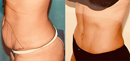 Tummy Tuck Patient Before & After Photo 1