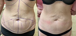 Tummy Tuck Patient Before & After Photo 1