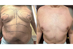 Gynecomastia Patient Before & After Photo 1