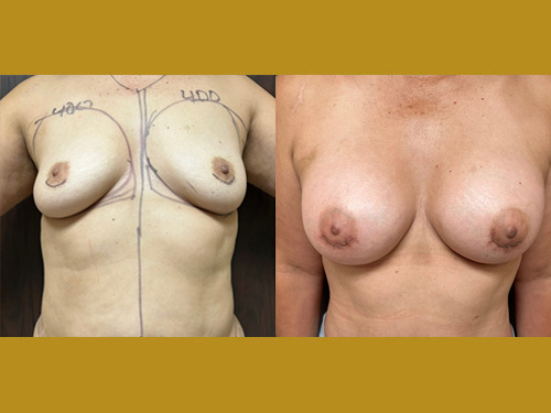 Breast Augmentation Patient Before & After Photo 1