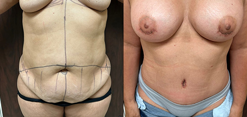 Tummy Tuck Patient Before & After Photo 1