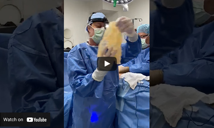 Ruptured Implant Video