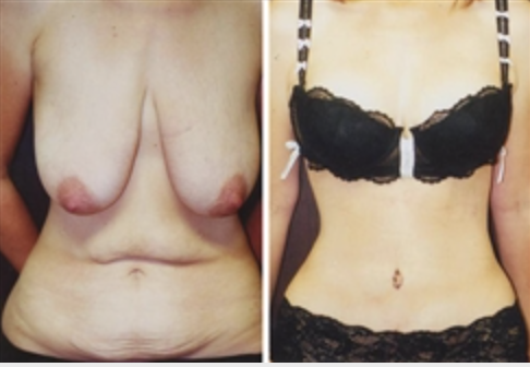 WEIGHT LOSS AFTER THE USE GLP-1 | Dr. Stuart A. Linder