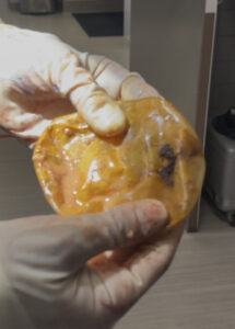 McGhan-ruptured-breast-implant