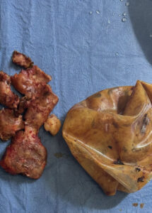 scar-tissue-and-ruptured-implant
