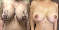 Breast Procedures Patient Before & After Photo 1