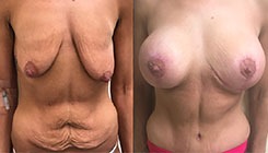 Breast Lift Patient 2 Results
