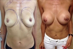 Breast Lift Patient 3 Results